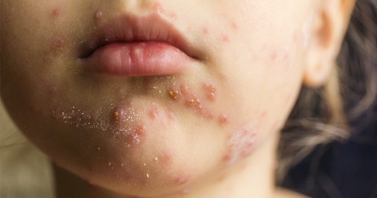 Woman with acne on her chin